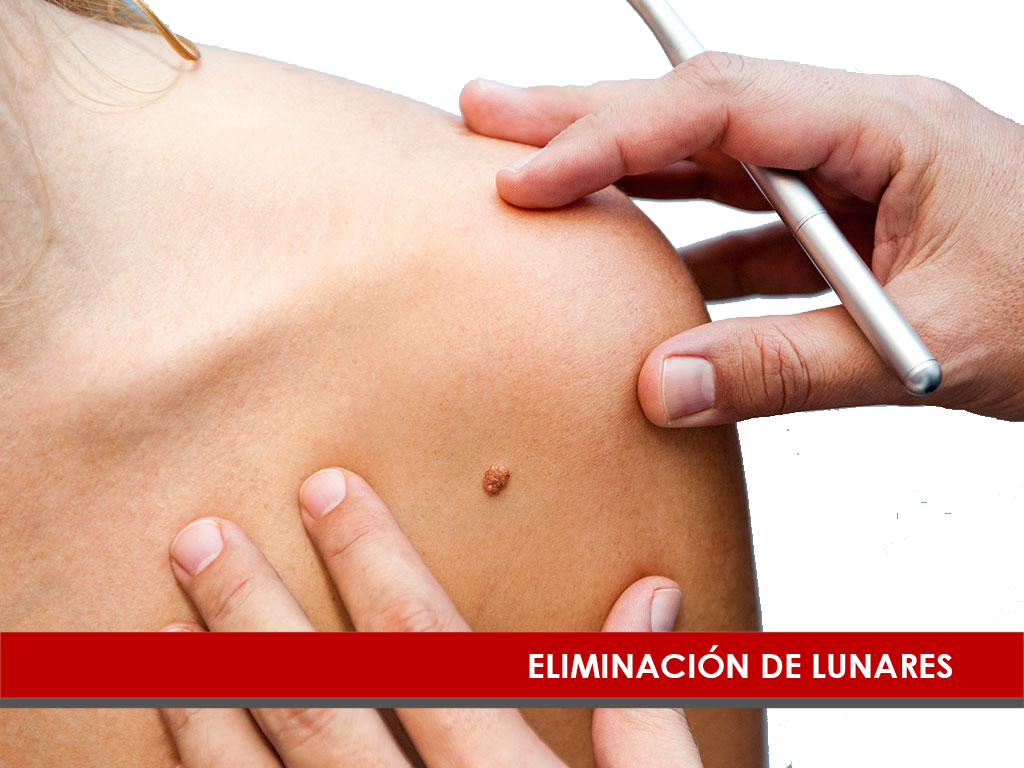 Eliminación de Lunares en El Salvador